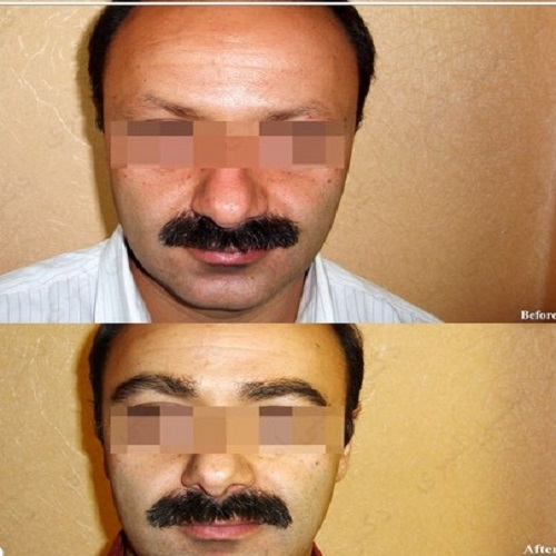 برداشت گرافت با مکش