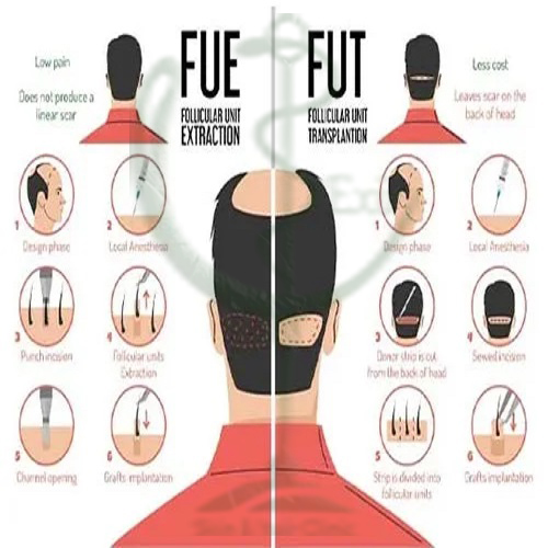 دو روش FUT یاFIT 