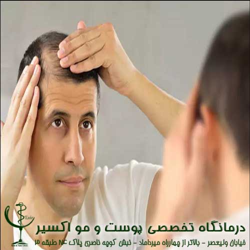 درباره دلایل ریزش مو چه می دانید