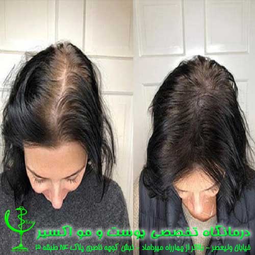 علاقة الاختلال في التوازن الهرموني لتساقط الشعر