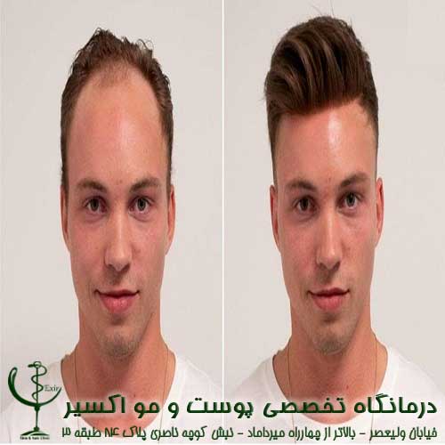 الموضوعات الهامة جدا حول زرع الشعر