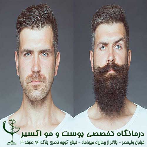 What is beard transplant used for?