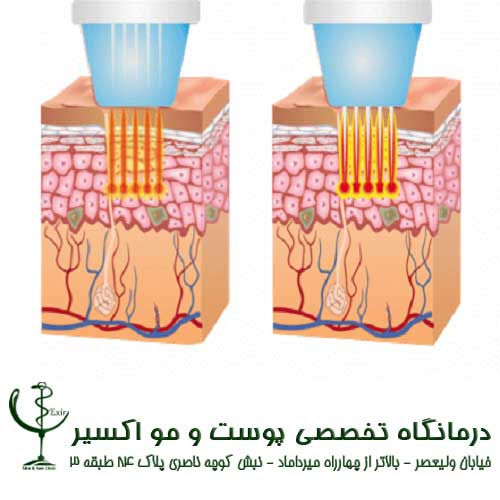 How radio frequency waves works in RF fractional?