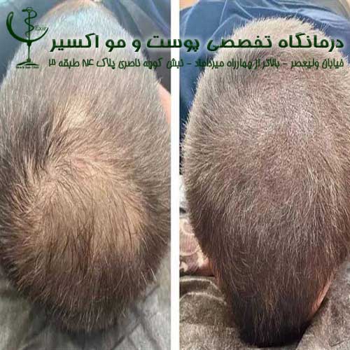 نصائح هامة وری عملیة زرع الشعر الطبیعی