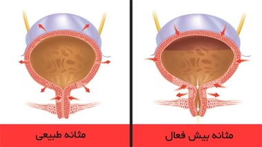 مثانه بیش فعال