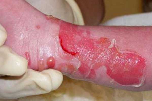 اپیدرمولسیس بیماری نادر پوستی