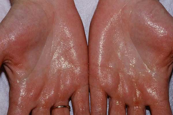 هایپرهیدروزیس بیماری عرق کردن کف دست