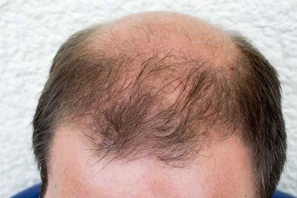 آلوپسیا و ریزش مو در مردان