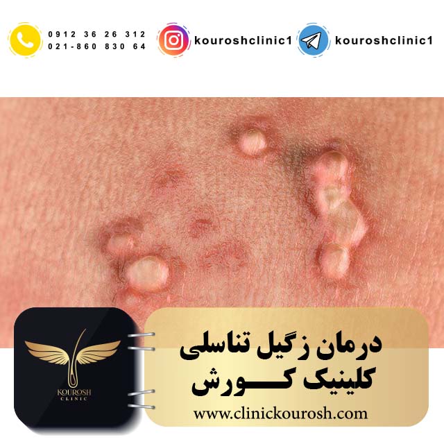 زگیل تناسلی HPV کلینیک کورش