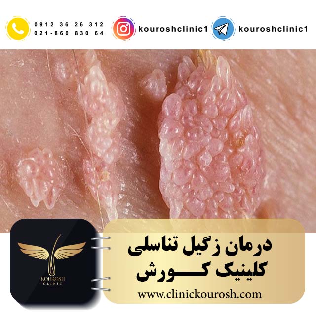 درمان زگیل تناسلی زنان و مردان