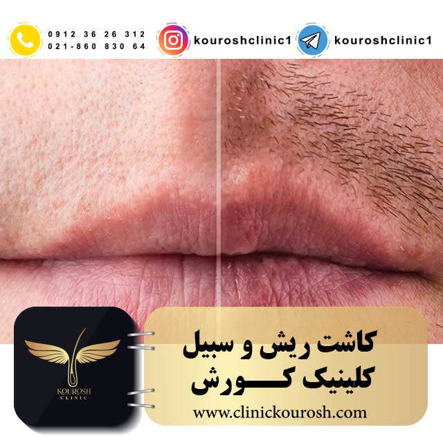پیوند و کاشت ریش