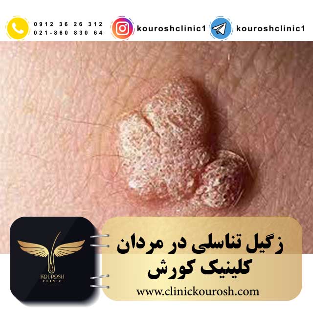 زگیل تناسلی در مردان