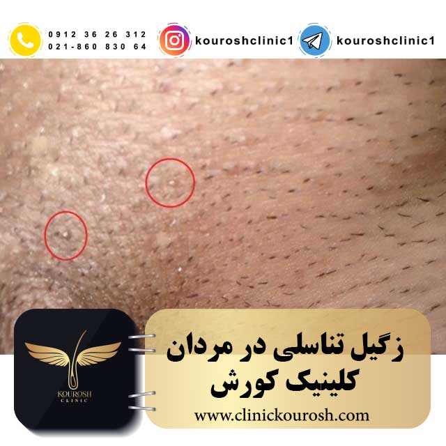درمان زگیل تناسلی در مردان