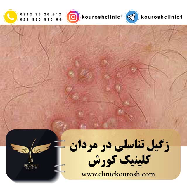 زگیل تناسلی
