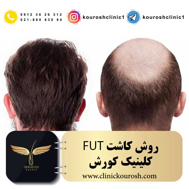 کاشت مو به روش fut