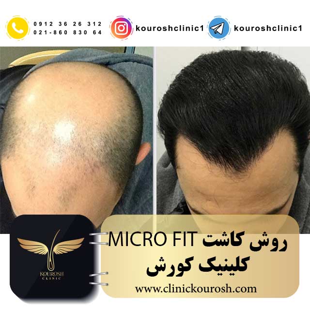 روش کاشت میکرو ف ی ت