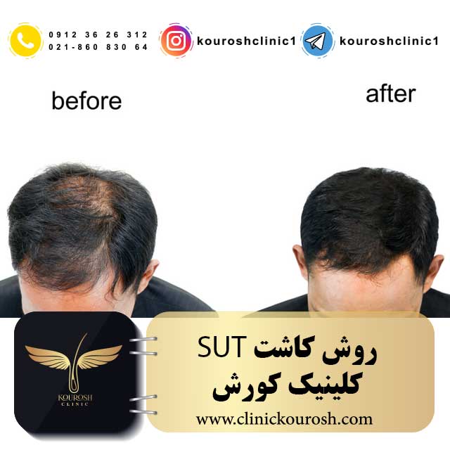 روش کاشت SUT