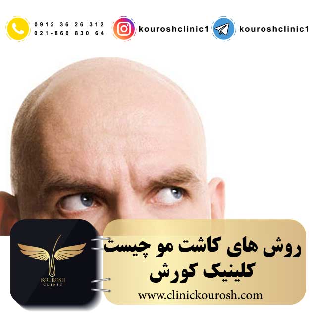 کاشت مو چیست ؟