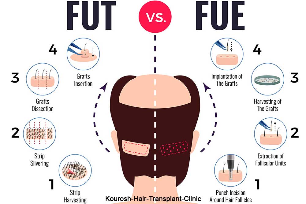 روش FUT یا روش FUE